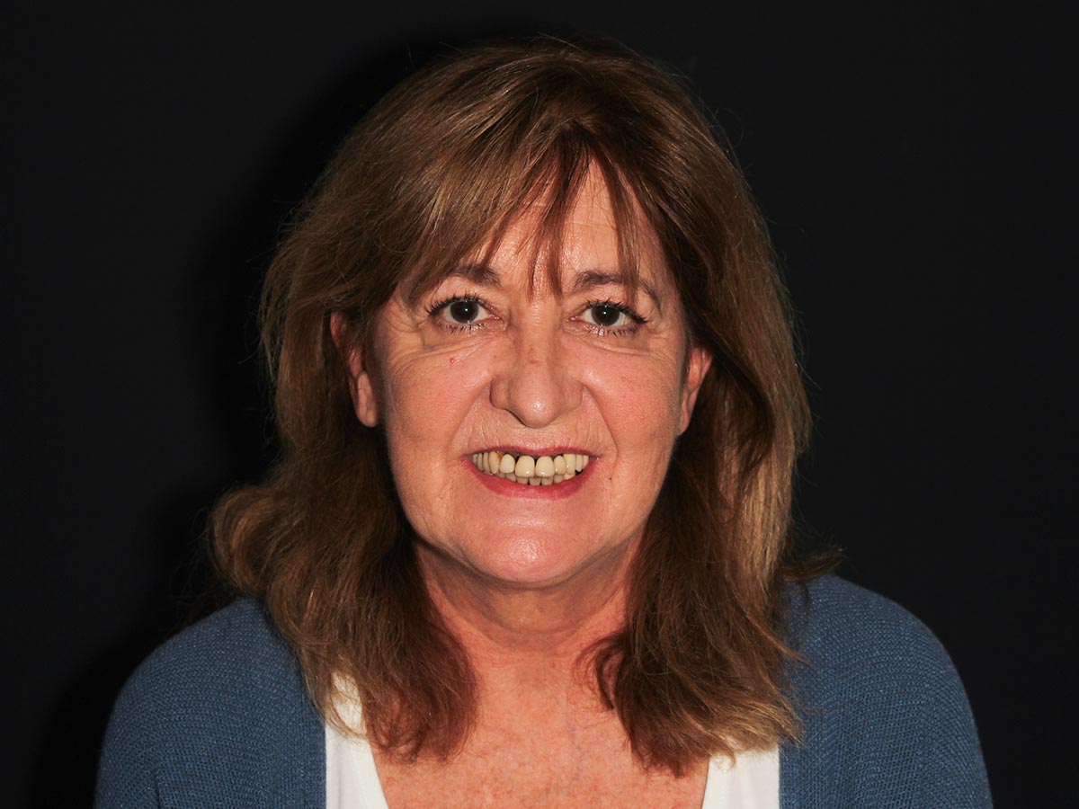 Resultado de la rehabilitación dental con DSD en Clínica Curull Tarragona — caso real de Ángeles
