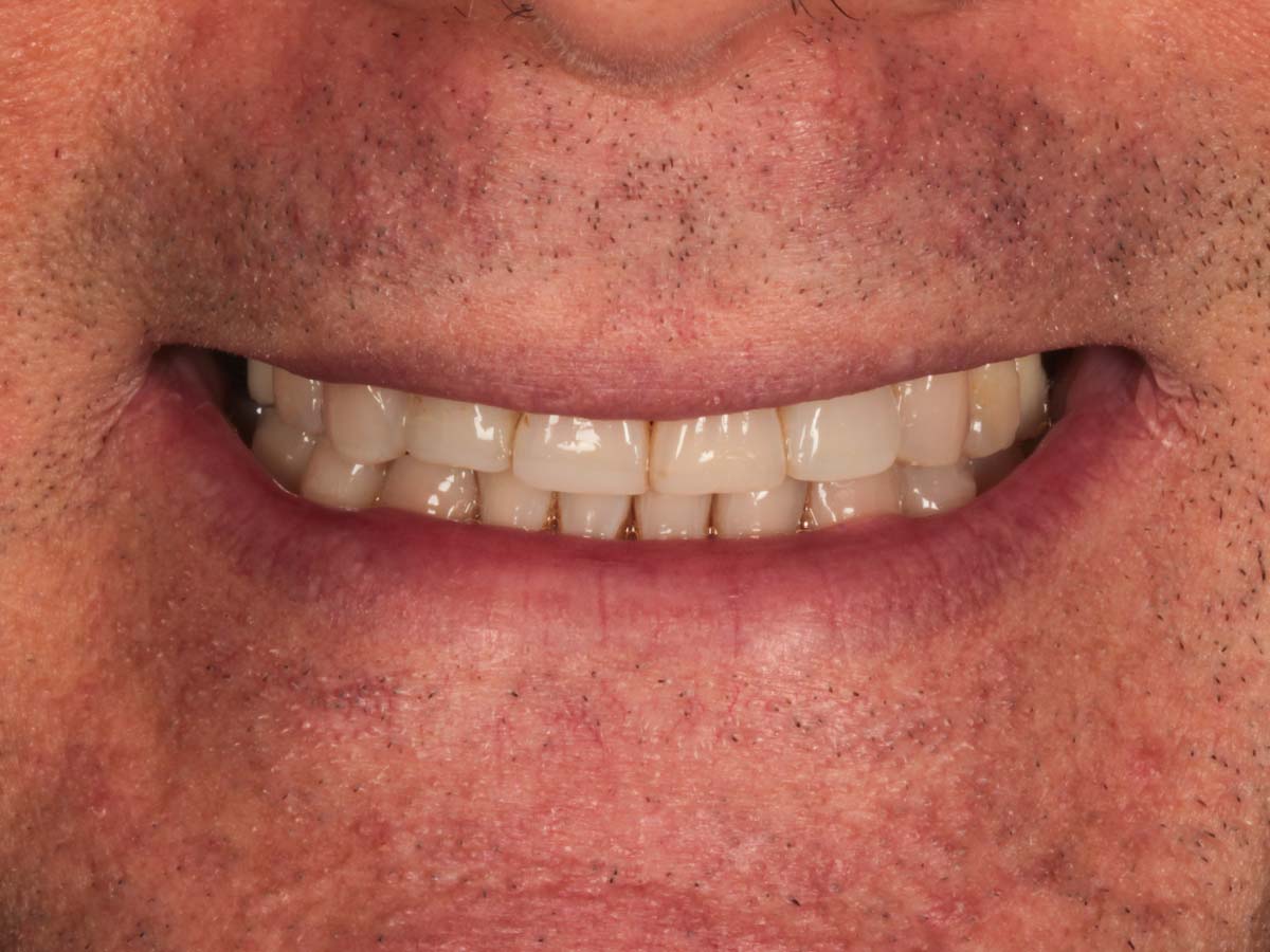 Detalle de la sonrisa después del tratamiento de ortodoncia invisible en Clínica Curull Tarragona — caso real de Álvaro