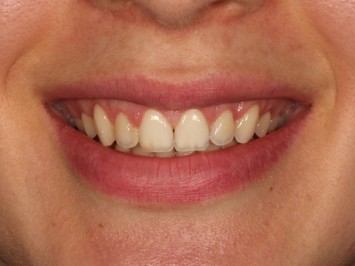 Detalle de la sonrisa después del tratamiento de sonrisa gingival en Clínica Curull Tarragona — caso real de Ana