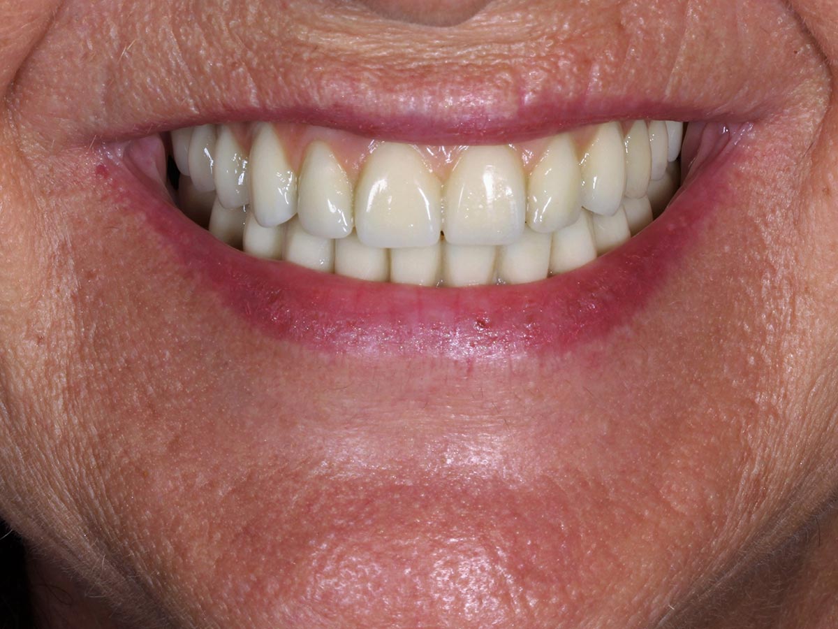 Resultado de la rehabilitación dental con DSD en Clínica Curull Tarragona — caso real de Ángeles