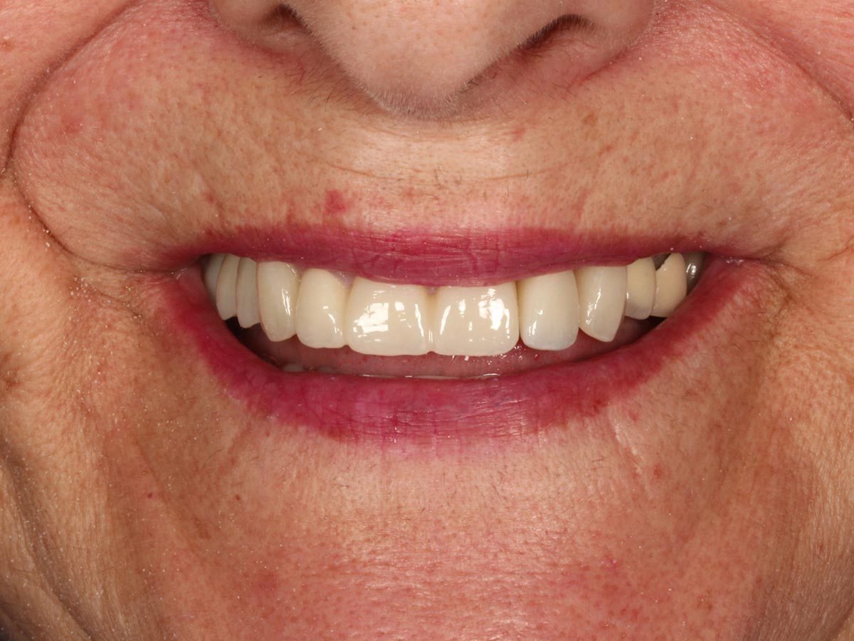 Detalle de la sonrisa después de la rehabilitación dental completa en Clínica Curull Tarragona — caso real de Cinta