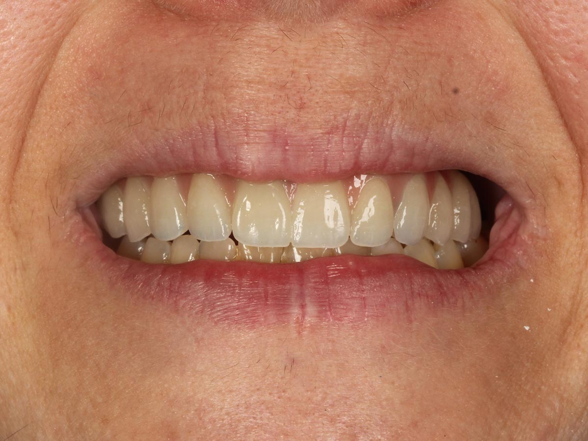 Detalle de la sonrisa después del tratamiento de implantes dentales con Sonrisa en 1 Día en Clínica Curull Tarragona — caso real de Elena