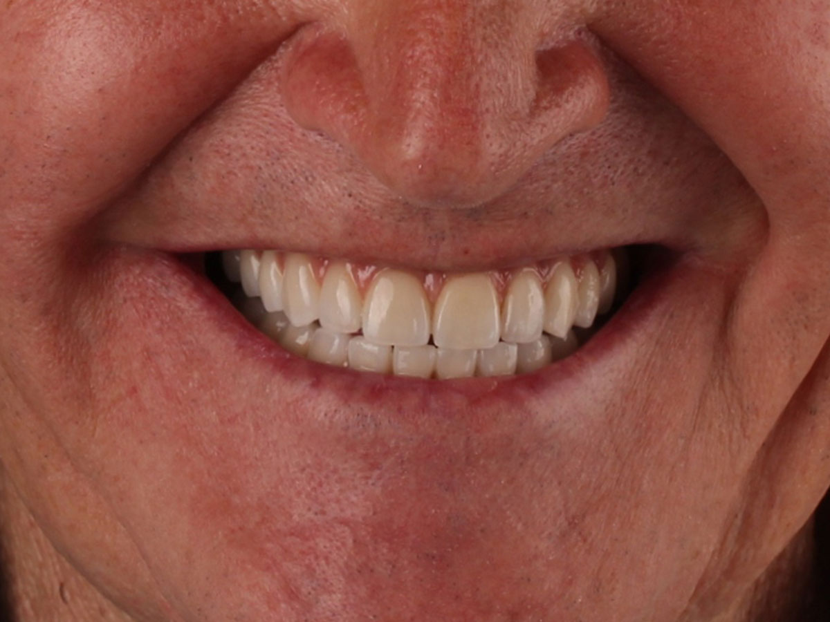 Detalle de la sonrisa después del tratamiento de implantes dentales con Sonrisa en 1 Día en Clínica Curull Tarragona — caso real de Josep