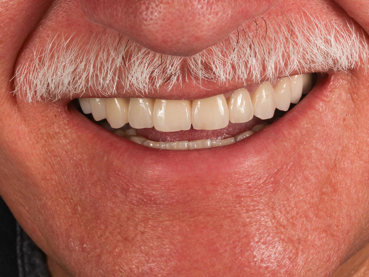 Detalle de la sonrisa después de los implantes dentales en 1 día en Clínica Curull Tarragona — caso real de Martín Morales