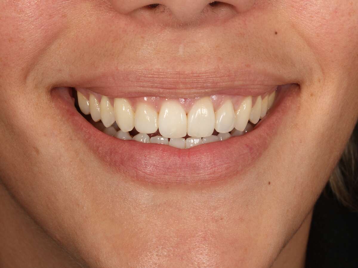 Detalle de la sonrisa después del tratamiento de ortodoncia invisible en Clínica Curull Tarragona — caso real de Elisabet