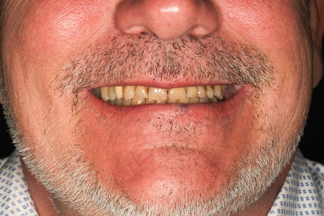 Sonrisa de Jose Luis antes de la rehabilitación dental completa en Clínica Curull Tarragona