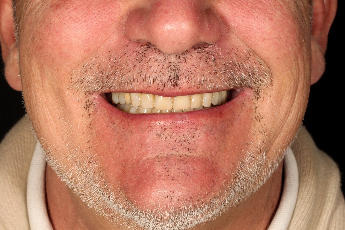 Sonrisa renovada de Jose Luis después de la rehabilitación dental completa en Clínica Curull Tarragona
