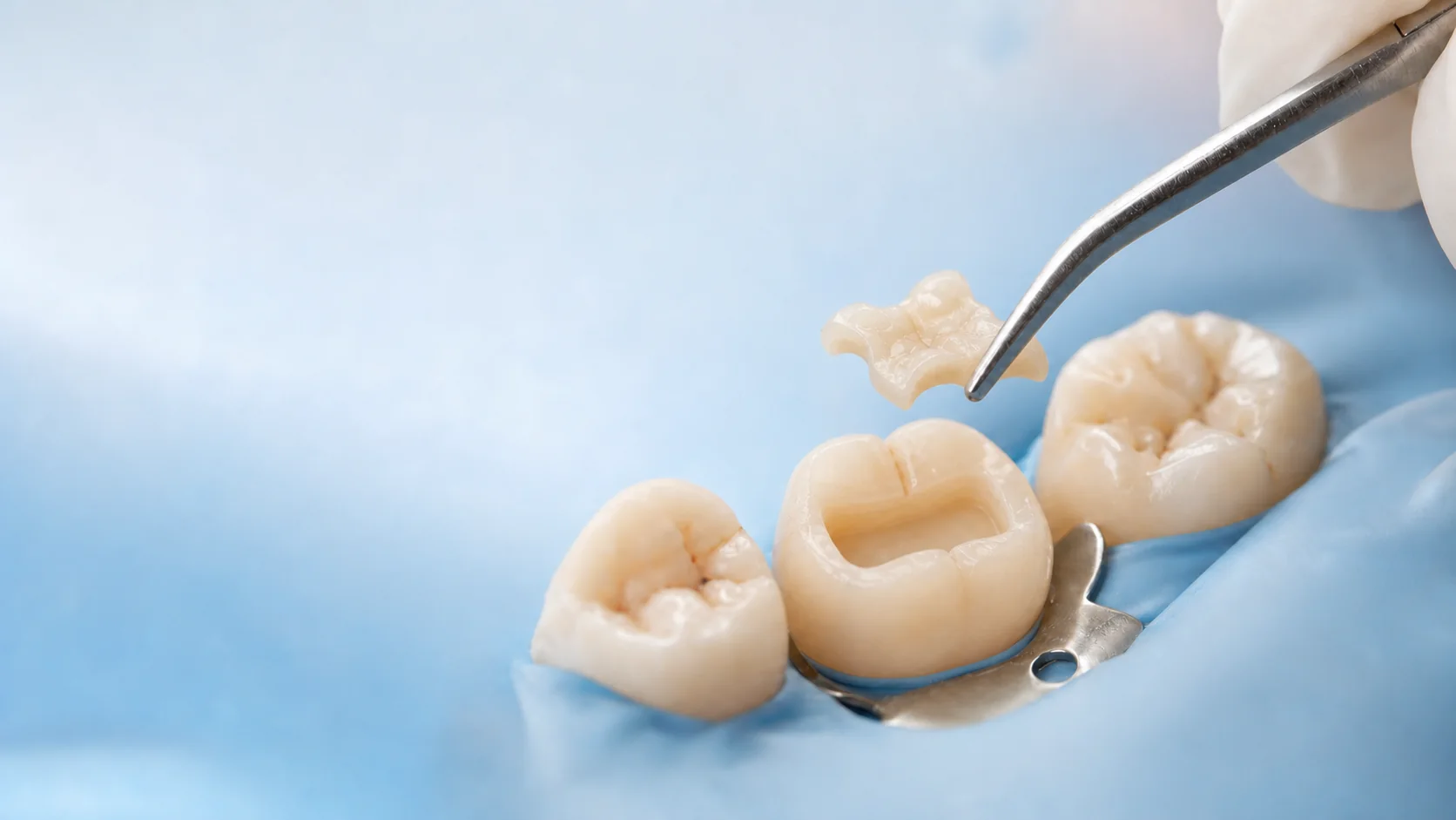 Beneficios de las incrustaciones dentales