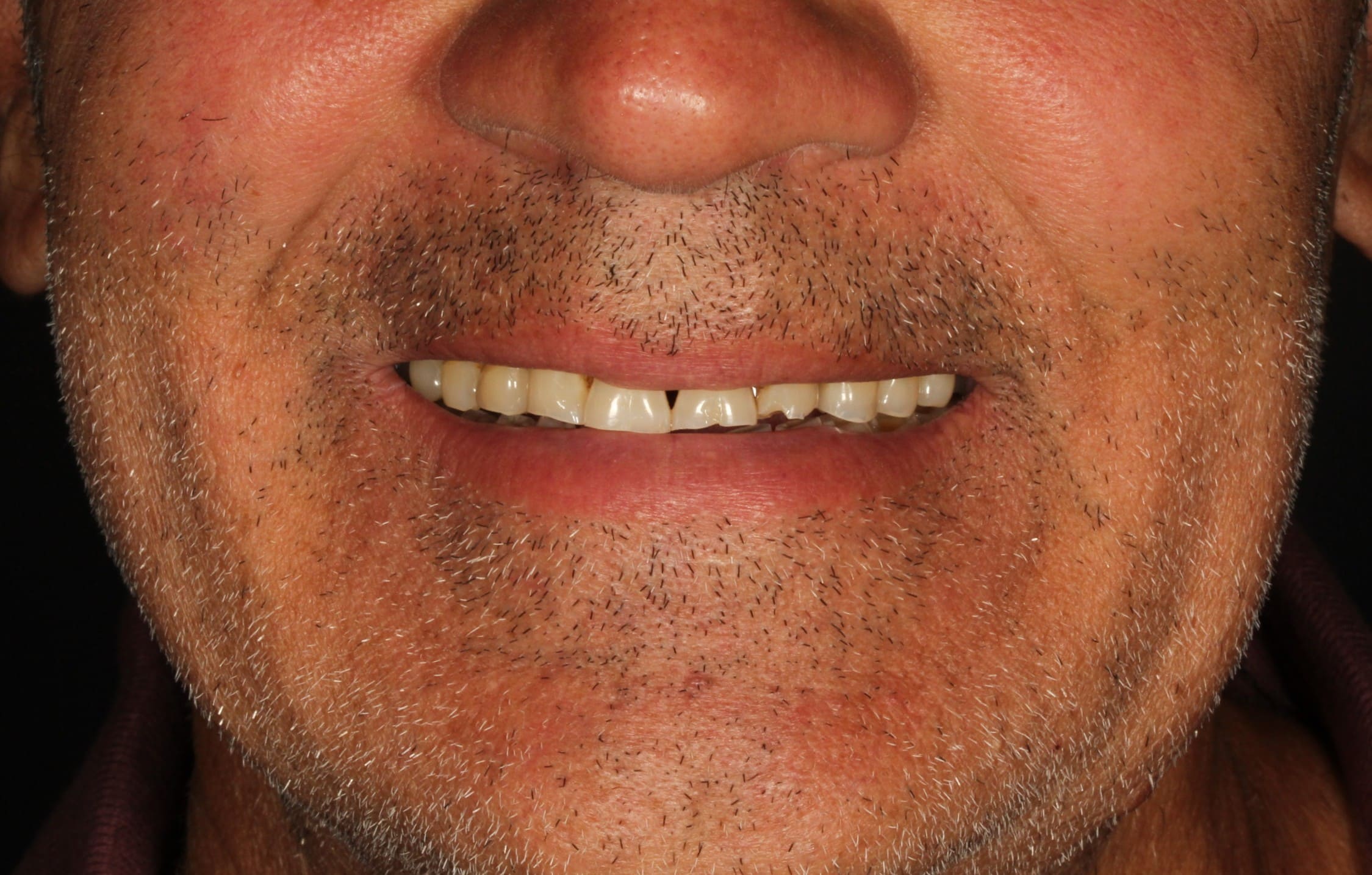 Sonrisa de Raimundo antes de la rehabilitación dental en Clínica Curull Tarragona