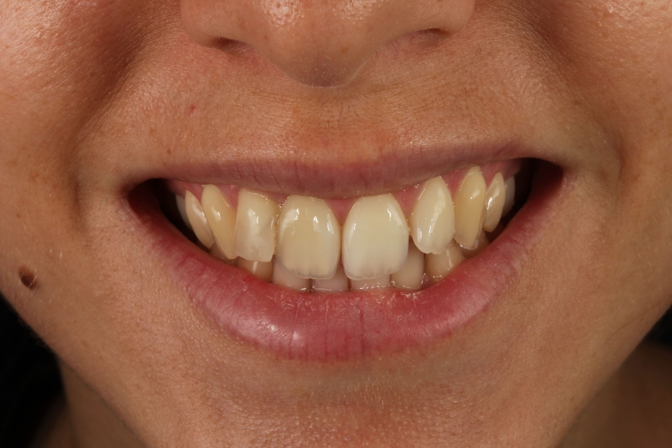 Sonrisa antes del blanqueamiento dental en Clínica Curull Tarragona