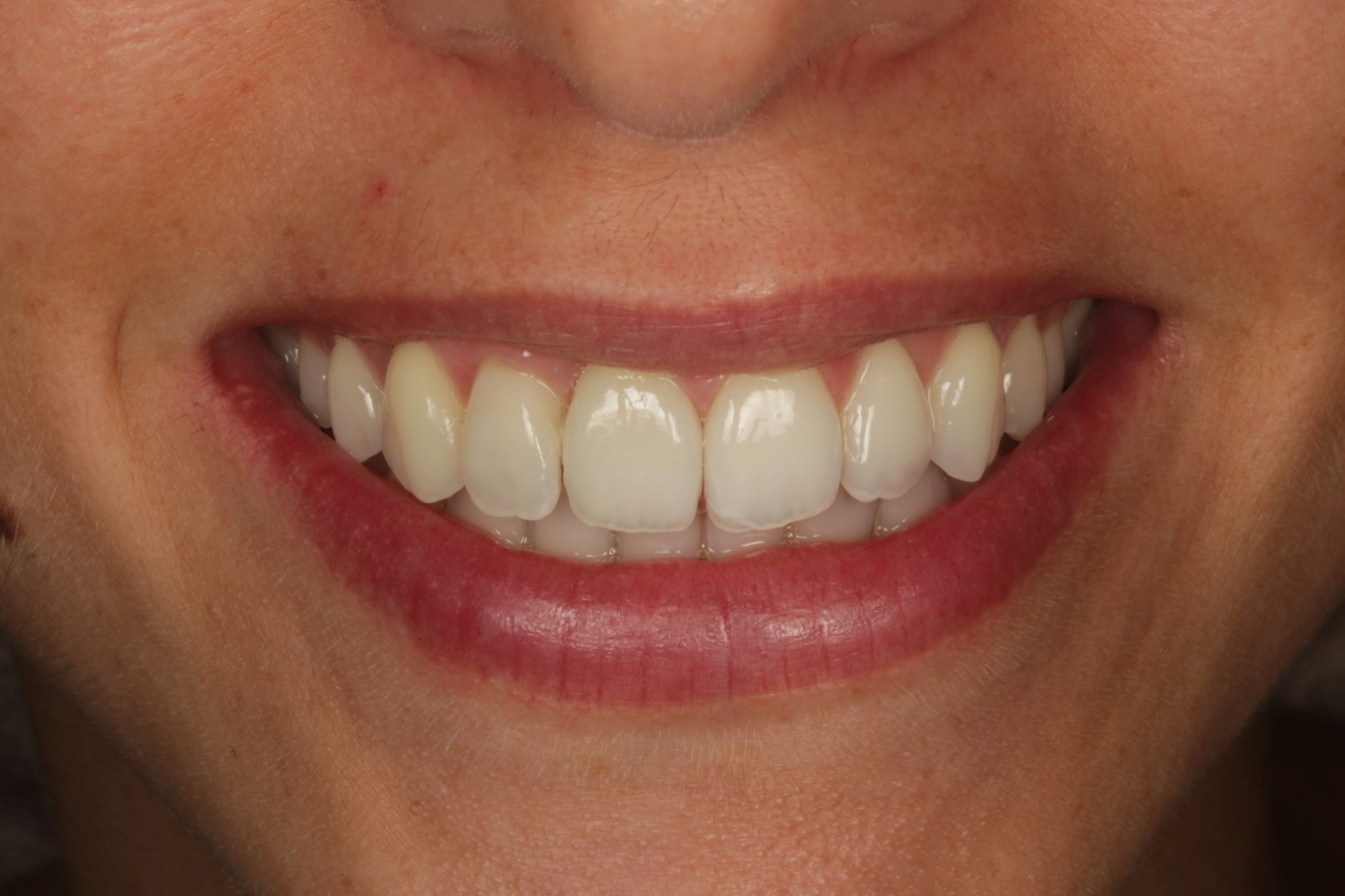 Blanqueamiento dental en clínica vs en casa: ventajas y resultados